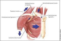 <p>SCM elevates medial fragment </p><p>trapezius FAILS to hold the lateral fragment </p><p>pec major pulls lateral fragment medially</p>