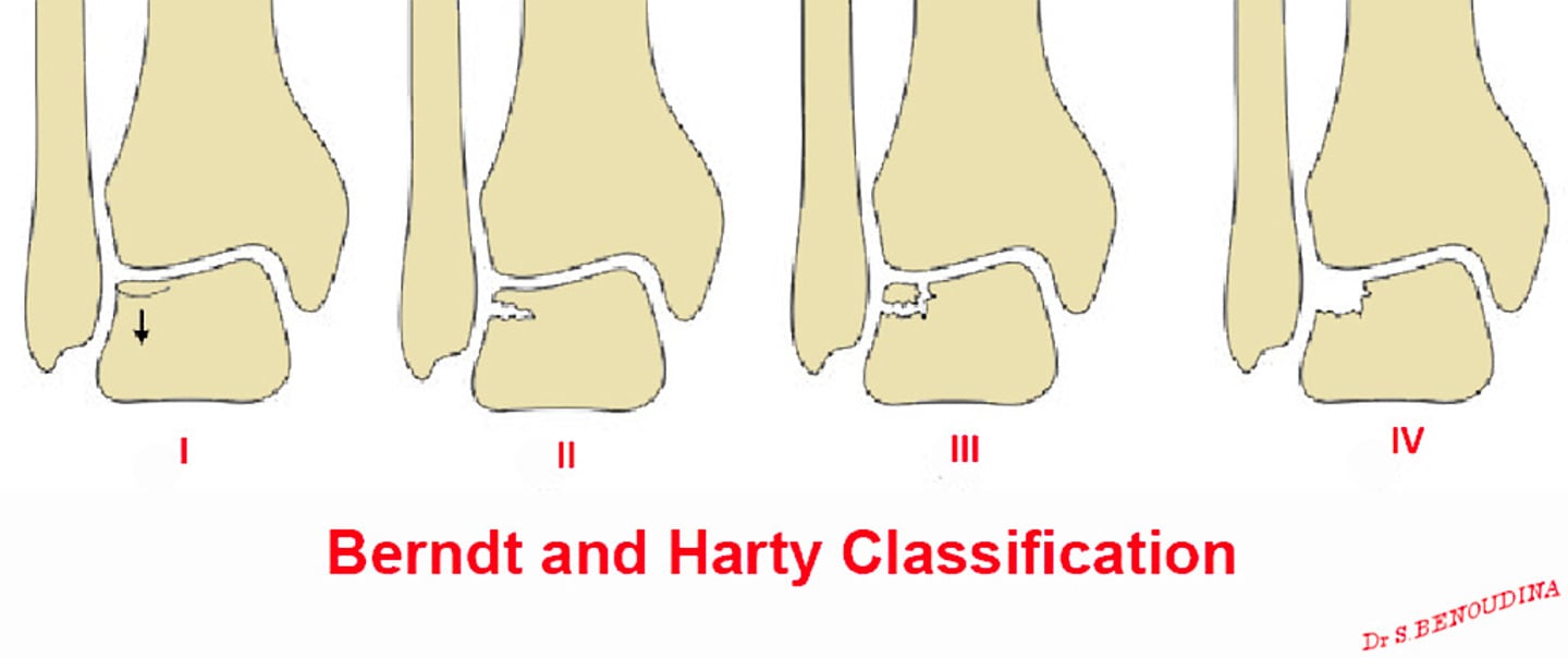 <p>BERNDT & HARDY - Talar dome fracture</p><p>Stage 1 - nondisplaced compression of talar dome</p><p>Stage 2 - partially detached osteochondral lesion</p><p>Stage 3 - completely detached, nondisplaced osteochondral lesion</p><p>Stage 4 - completely detached, displaced osteochondral lesion</p>