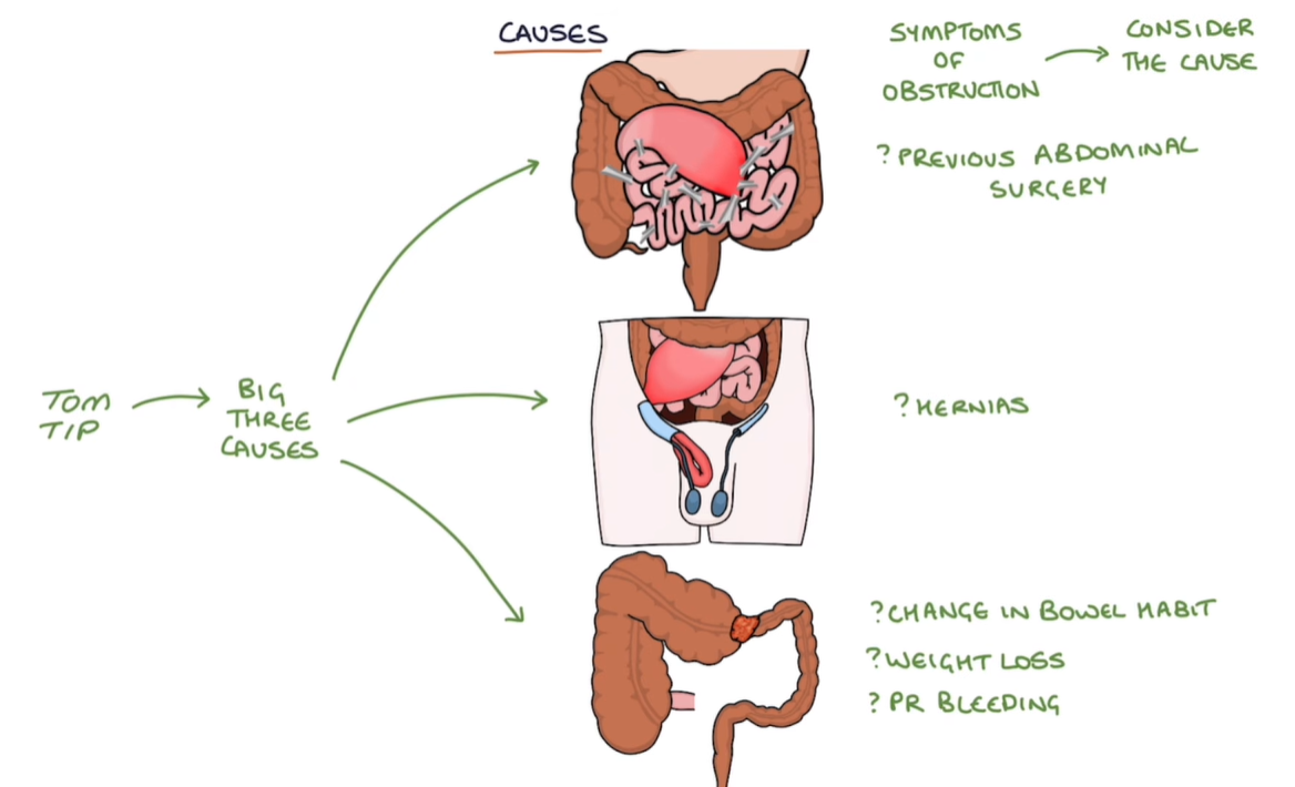 <ul><li><p>Intraperitoneal adhesions (fibrous band of scar tissue)</p></li><li><p>Tumors</p></li><li><p>Hernias <br></p></li><li><p>Meconium plug in newborns → meconium ileus). </p></li></ul><p></p>