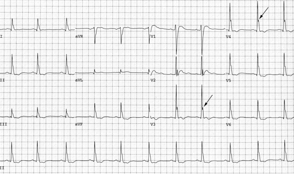 <p>EKG changes hypercalcemia</p>