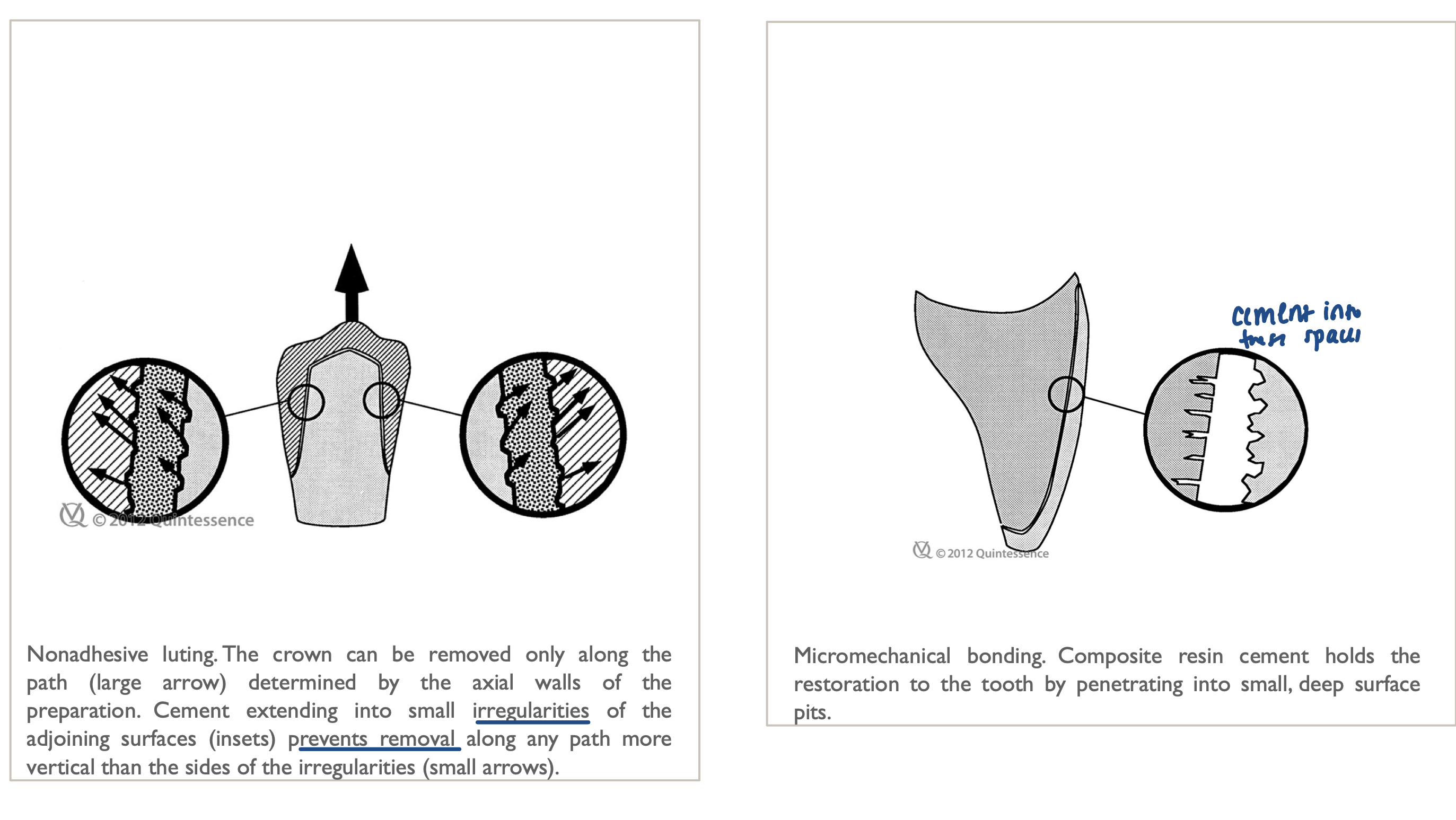 <p><strong>Non-adhesive luting</strong><span> relies purely on macro-mechanical friction and geometry to hold restorations in place, filling gaps with cements like zinc phosphate. In contrast, </span><strong>micromechanical bonding</strong><span> uses acid etching and primers to create microscopic surface porosities, allowing resin cements to interlock with the tooth and restoration for significantly higher strength and sealing</span></p>