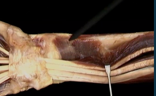 <p>Onder arm diep, anterior zicht</p>