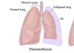 <p>air in the pleural space</p><p>will be treated with chest tube</p>