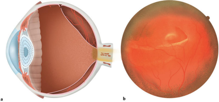 <ul><li><p>Can occur as the vitreous detaches from the retina</p><ul><li><p>Strong adhesions rip the retina off the RPE</p></li></ul></li></ul><p></p>
