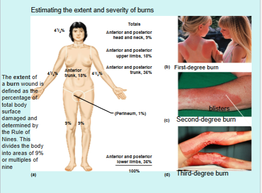 <ul><li><p>Tissue damaged by intense heat, radiation, electricity, and chemicals such as acids</p></li><li><p>Classified based on severity:</p><ul><li><p>First-degree burns: damage confined to only the epidermis; associated with redness, swelling, and pain; heal in 3 days without medical intervention (example: sunburn)</p></li><li><p>Second-degree burns: damage to entire epidermis and the papillary layer of the dermis; associated with blisters (fluid collection at epidermal-dermal junction), swelling, redness, and pain; heal in 3-4 weeks if infection is prevented</p></li><li><p>Third-degree burns: damage to entire skin = damage to entire epidermis and dermis, including nerve endings; burn site is not painful; subjected to infections and fluid loss; medical intervention involving grafting, fluid, protein, and ion replacement required for healing </p></li></ul></li></ul><p></p>