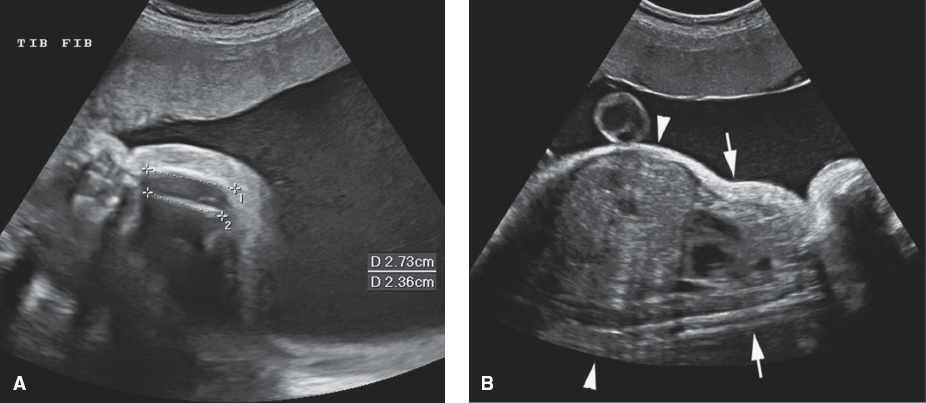 <p>Severely shortened limbs (micromelia)</p><p>Absent mineralization of the skull, spine, pelvis, and limbs</p><p>Large skull</p><p>Narrow chest and distended abdomen</p><p>Polyhydramnios</p><p>Osteogenesis Imperfecta</p>