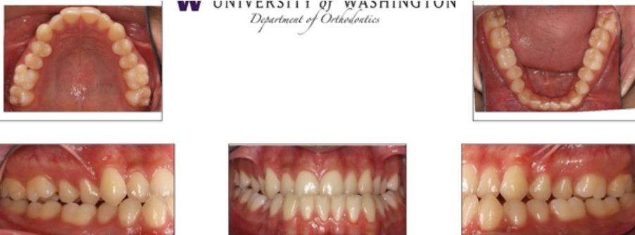 <p>What is the Angle's classification for this patient?</p>