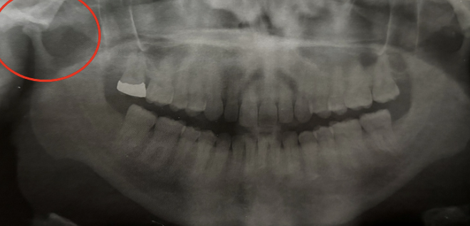 <p>underdeveloped condyle; due to congenital or acquired </p>