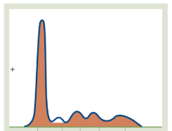 <ul><li><p><span style="background-color: transparent; font-family: "Times New Roman", serif;">The Pattern: A complete absence or near-total </span><span style="font-family: "Times New Roman", serif;">flattening of the α1 peak</span><span style="background-color: transparent; font-family: "Times New Roman", serif;">.</span></p></li><li><p><span style="background-color: transparent; font-family: "Times New Roman", serif;">Why: Since </span><span style="font-family: "Times New Roman", serif;">α1-antitrypsin makes up about 90%</span><span style="background-color: transparent; font-family: "Times New Roman", serif;"> of the α1 globulin fraction, its </span><span style="font-family: "Times New Roman", serif;">genetic absence</span><span style="background-color: transparent; font-family: "Times New Roman", serif;"> leaves a visible "void" in the graph. This is often linked to early-onset emphysema or liver cirrhosis.</span></p></li></ul><p></p>