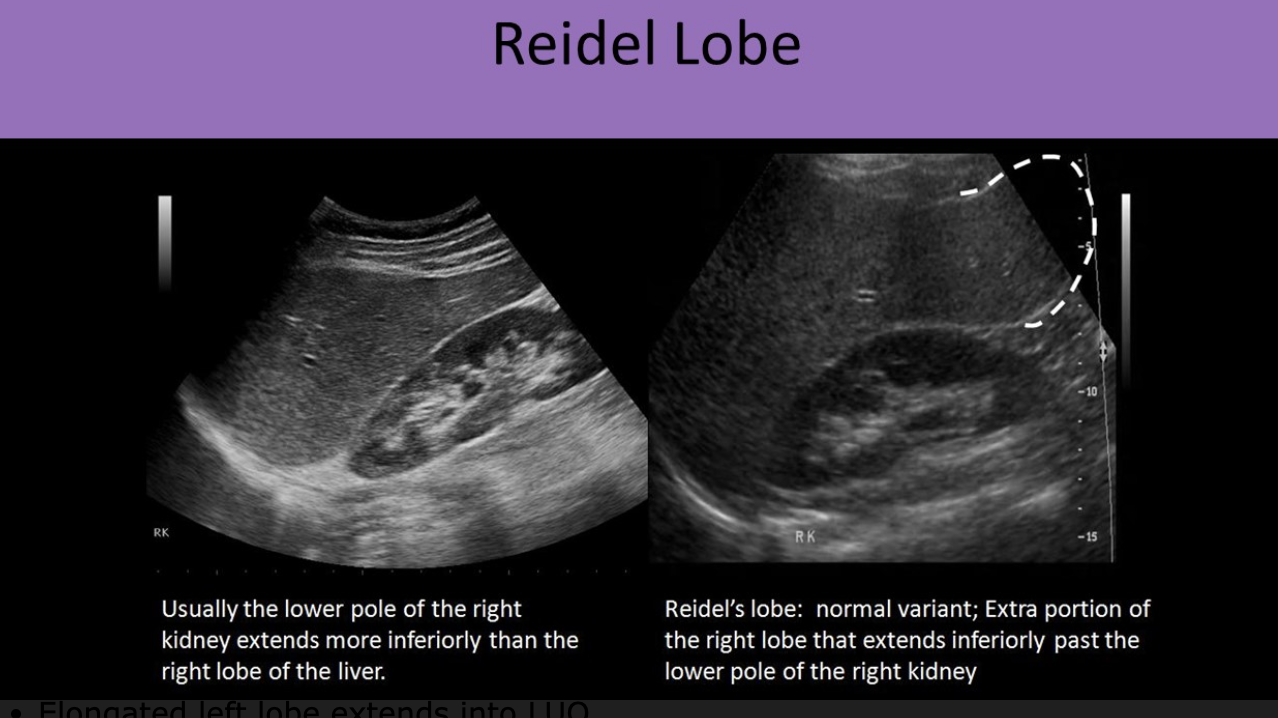 <ul><li><p>an extension of the right, inferior lobe of the liver below the lower pole of the right kidney</p></li><li><p>common with women</p></li><li><p>normal liver echotexture</p></li><li><p>normal left lobe</p></li><li><p>normal AP dimension of right lobe</p></li></ul><p></p><p></p>