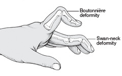 <p>Observer deformity is ext. of MCP ext. of the DIP along with flex. Of PIP. Common with rheumatoid arthritis with degeneration of central extensor tendon.</p>