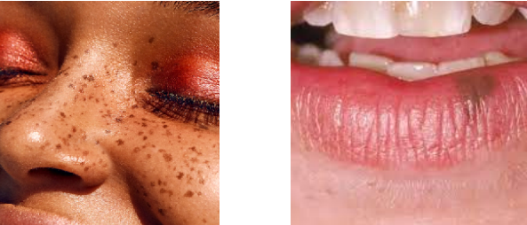 <p><span style="color: red;">light brown to black</span></p><p>deeper &amp; heavier the deposit of melanin, the more darker it appears</p><p>lightly tanned individuals → even coloration but dark complexion frequently have macules of pigmentation</p>