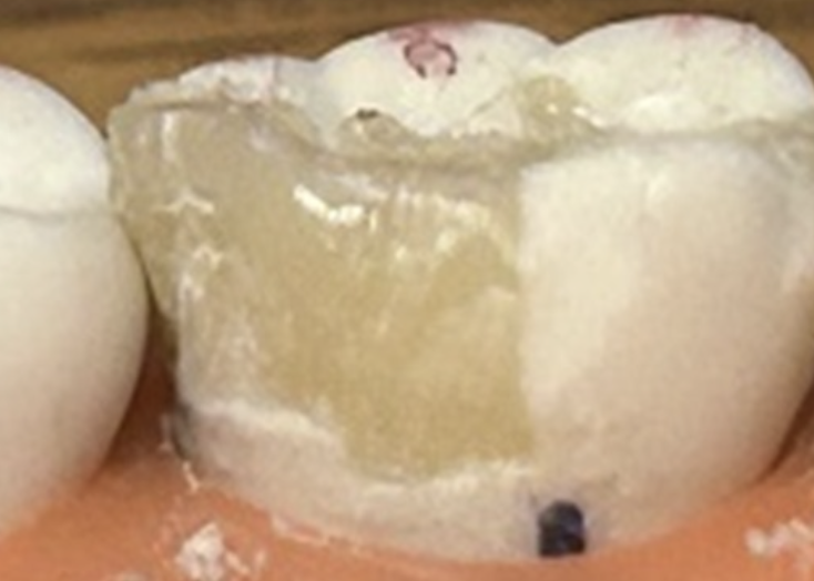 <p>This is an example of _____ side interference</p>