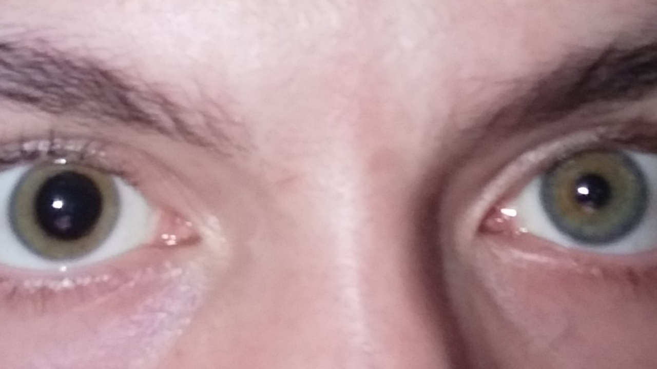 <p>unequal pupil size</p>