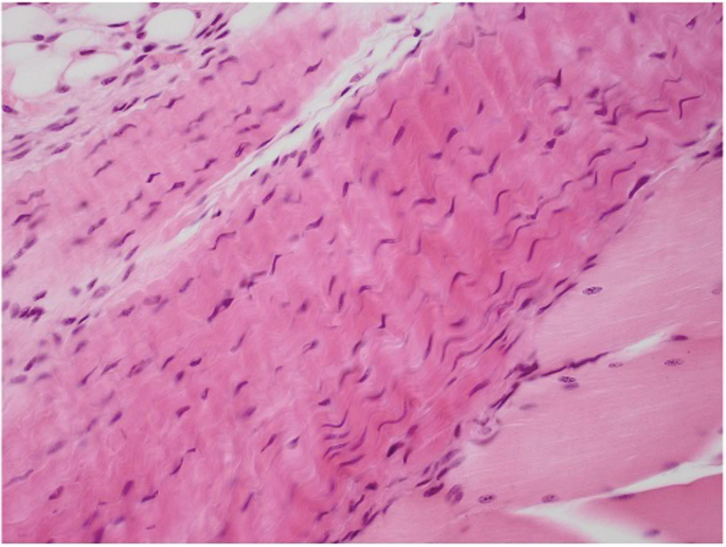 <p>Thick fibers packed tightly together, organized same direction fibers, Fibroblast nuclei between fibers appear thin and long, very little open space. </p>