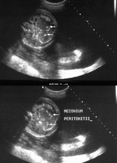 <ul><li><p><span style="color: red;">calcifications seen on peritoneal surfaces </span>or in scrotum via processus vaginalis</p></li><li><p>ascitic fluid may be echogenic</p></li></ul><p></p>