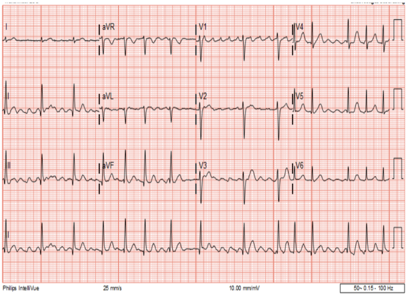 <ul><li><p>lijkt wel op zaagtandpantroon → maar hartritme volledig onregelmatig = atriumfibrilleren</p></li></ul><p></p>