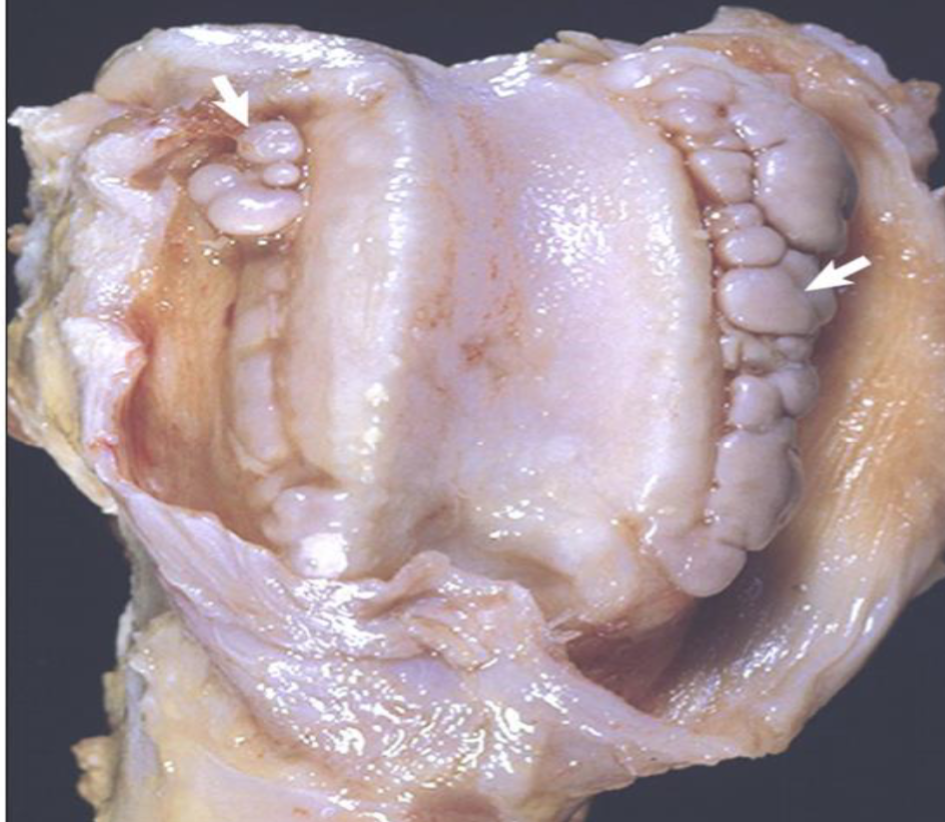 <p>osteophytes - geneally a response to skeletal stress </p><p>lateral outgrowths of bone that are fromed by chondrification (meaning cartilage is layed doen first then its ossifiied) </p>