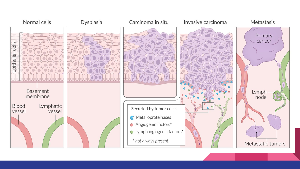 <p>The phenotypic progression of neoplasia involves dysplasia (abnormal growth), carcinoma in situ (full-thickness dysplasia without invasion), invasive carcinoma (penetration through the basement membrane), and metastatic carcinoma (spread to distant sites).</p><p></p><p><span>Normal Epithelium → Dysplasia → Carcinoma in Situ → Invasive Carcinoma → Metastatic Carcinoma. </span></p>
