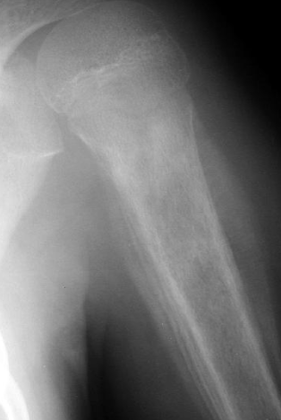 <p>__ radiographic appearance seen in Ewing sarcoma (periosteal reaction “like Garre’s osteomyelitis”)</p>