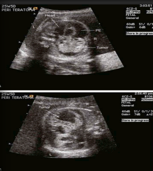 <p>They have hemodynamic consequences in utero and grow rapidly </p><p> May cause tamponade and are associated with hydrops up to ~80%</p><p>(Intervention in utero is necessary)</p>