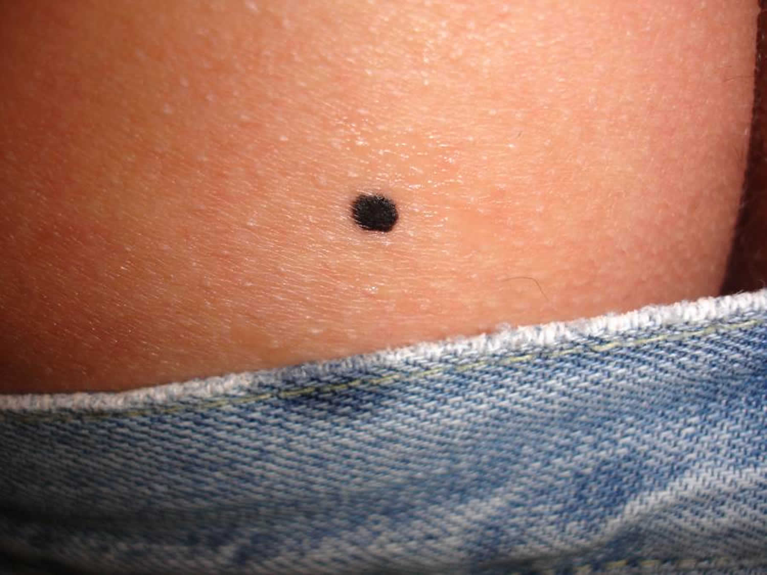 <p>Pigmented Nevi</p>