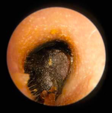 <p>Cerumen Impaction</p>