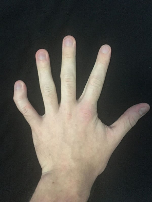 <p>What term best describes the hand anomaly?</p><p>a) Postaxial polydactyly</p><p>b) 1st finget clinodactyly</p><p>c) Preaxial polyfactyly</p><p>d) 5th finger clinodactyly</p>