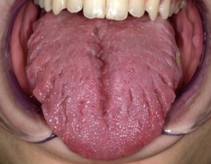 <p>Surface Texture : a cleft or groove, normal or otherwise, show prominent depth </p>