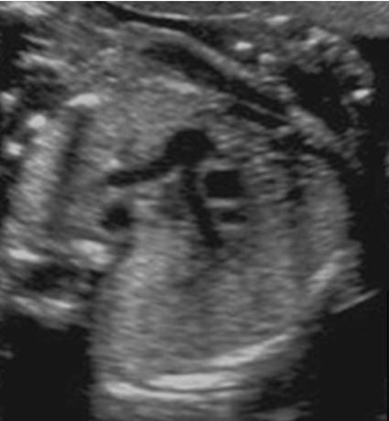 <p>Locate the ascending aorta</p>