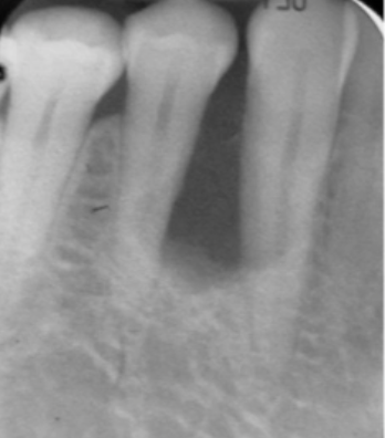 <p>what is the managment of this lesion? </p>