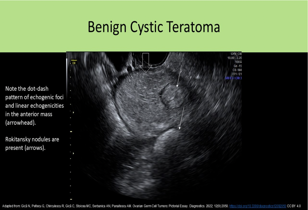 <p>A. cystic teratoma</p><p>Ectodermal tissue refers to teeth, hair, bone tissue. A cystic teratoma (dermoid) is composed of a mixture of ectodermal tissue.</p>