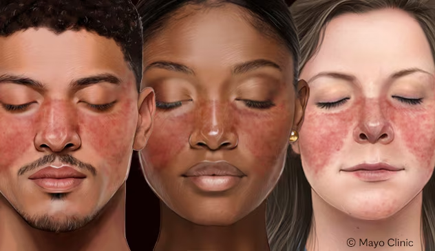 <ul><li><p><span style="background-color: transparent; font-family: "Times New Roman", serif;">Butterfly rash across the face</span></p></li></ul><p></p>