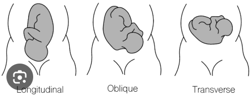 <p><strong> Fetal Lie: </strong>the relation of the long axis (spine) of the fetus to the long axis (spine) of the mother</p><p> Longitudinal: Ideal position</p><p> Transverse</p><p><strong> Fetal Attitude:</strong> the relation of the fetal body parts to one another</p><p></p>