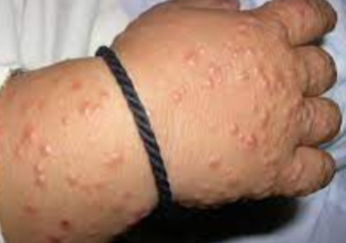 <p>Gianotti-Crosti Syndrome (Papular acrodermatitis of childhood)</p>