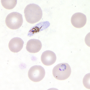 <ul><li><p>infects any and all RBCs</p></li><li><p>cresent-shaped gametocyte (sexual stage) (upper left of picture)</p></li><li><p>frequently shows multiple rings in one RBC</p></li><li><p><strong>20-24 merozoites in schizonts</strong></p></li></ul><p></p>