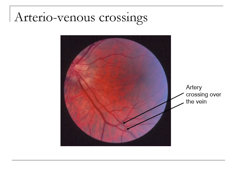 <p>BRVO results from compression of a branch retinal vein at an arteriovenous (AV) crossing, usually due to arterial sclerosis.<br>The superior temporal retina is most affected because it has the highest number of AV crossings, increasing the likelihood of venous compression and occlusion.</p>