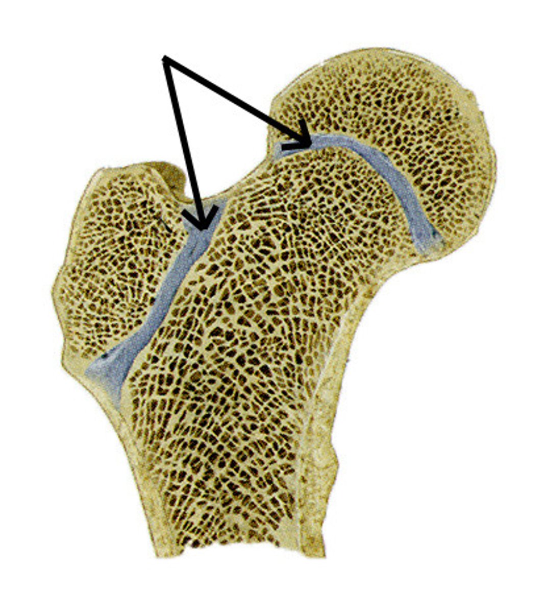 <p>Remnant of growth plate.</p>