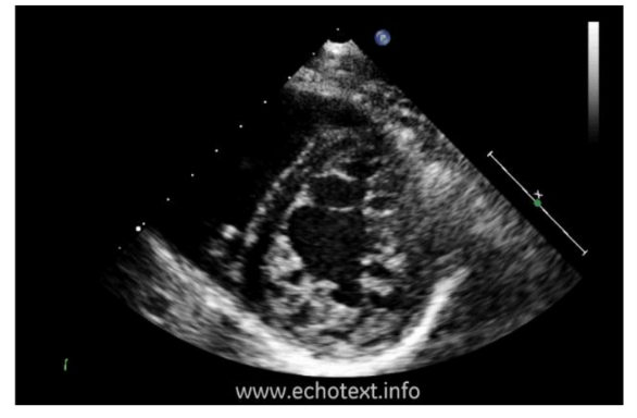 <p>What is <em>Left Ventricular Noncompaction</em></p>