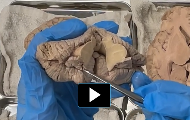 <p>postero-lateral fissure </p>