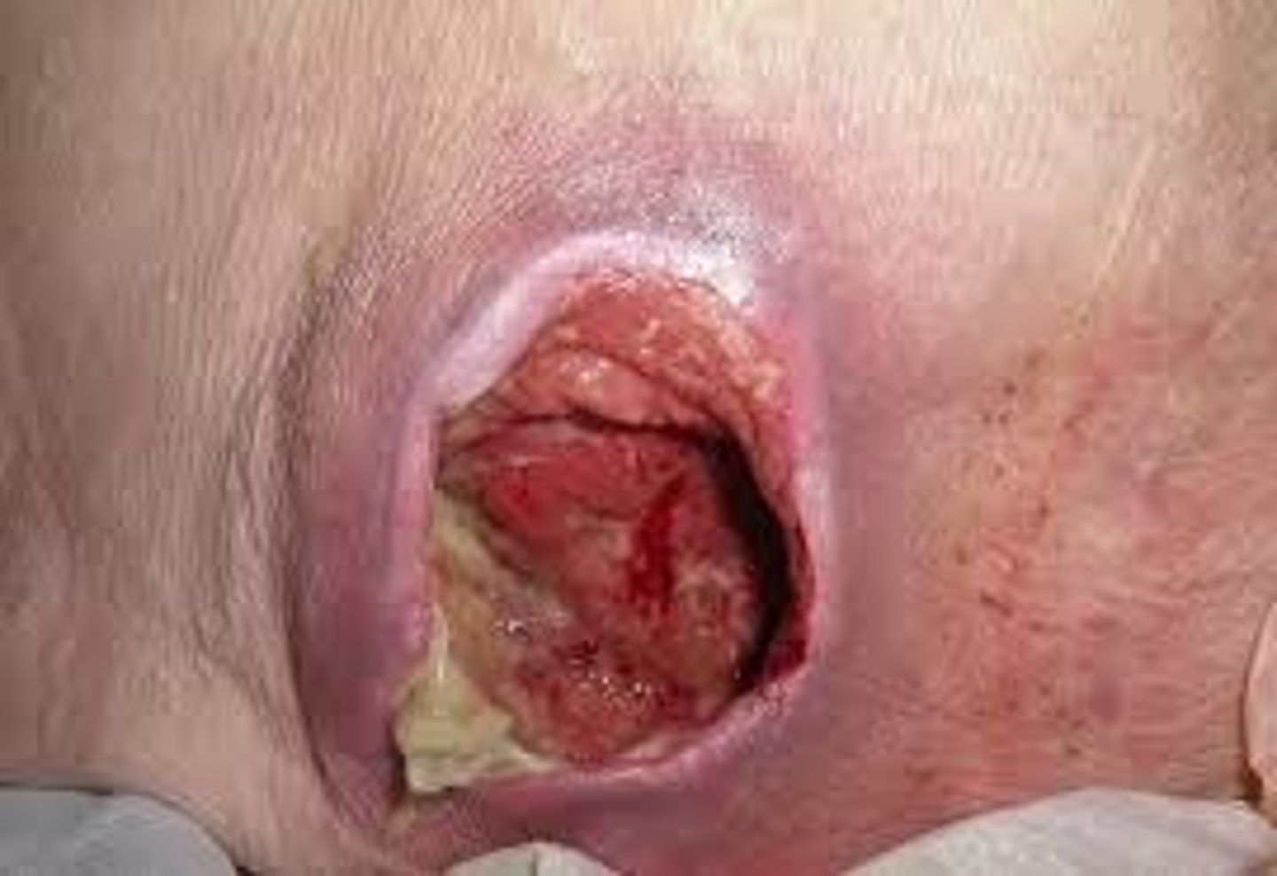 <p>localized injury to the skin caused by unrelieved pressure or pressure with shear; results in damage of underlying tissue</p>