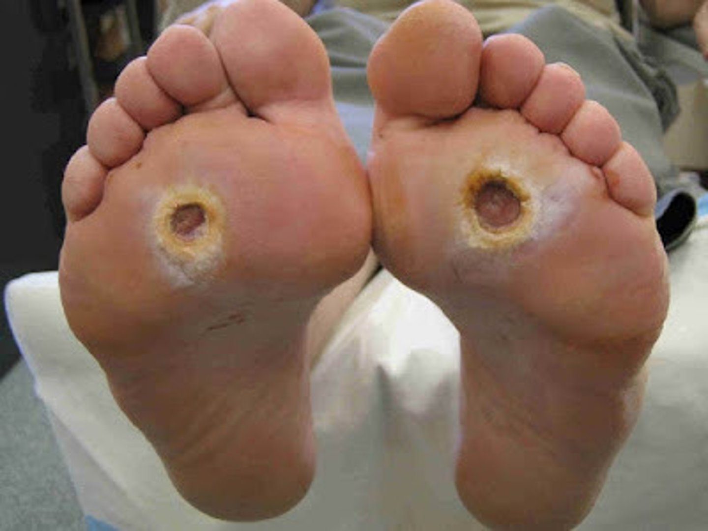 <p>causes: hyperglycemia, decreased sensation, increased plantar foot pressure</p><p>clinical presentation: usually along pressure points, punched out appearance, deep w/ calloused edges, not painful, minimal drainage, dry cracked skin, callous</p><p>treatment: offload, glucose control, non-occlusive dressing</p><p>Use Wegener scale to grade</p>