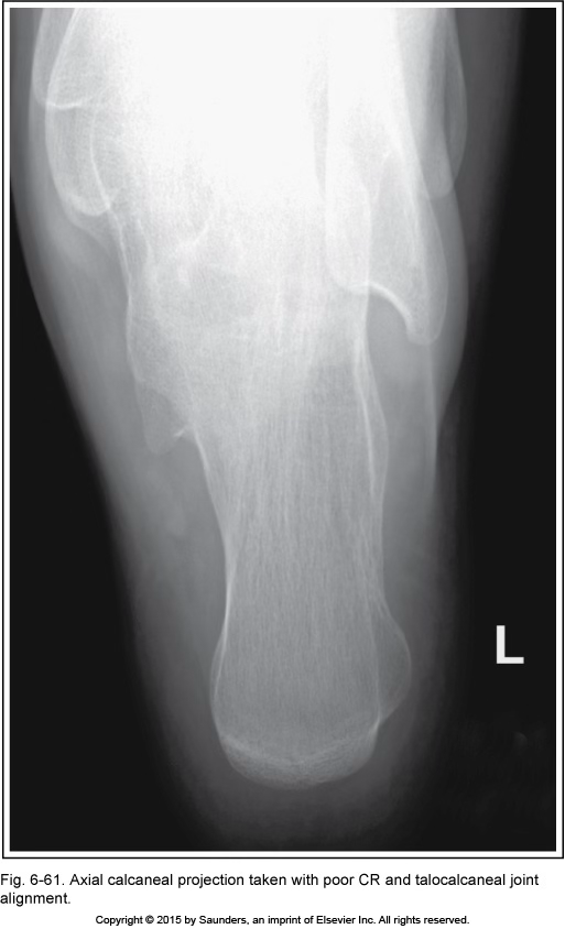 <p>Axial calcaneus</p>