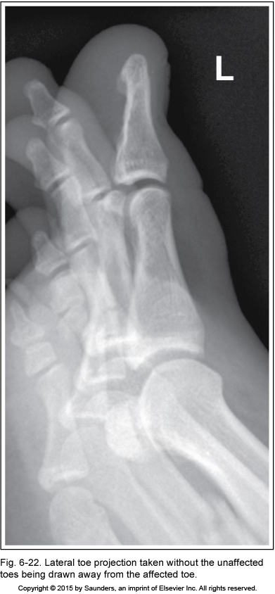 <p>lateral toe</p>