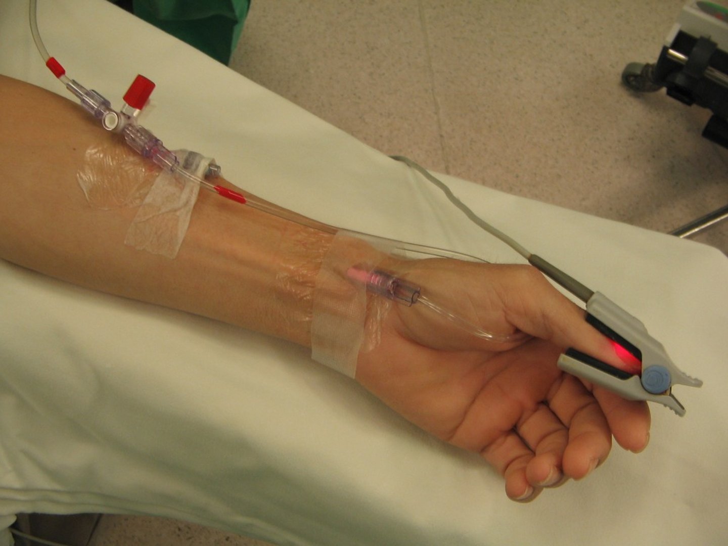<p>thin catheter inserted into an artery that measure arterial blood pressure; can be used to draw blood/deliver medications</p>
