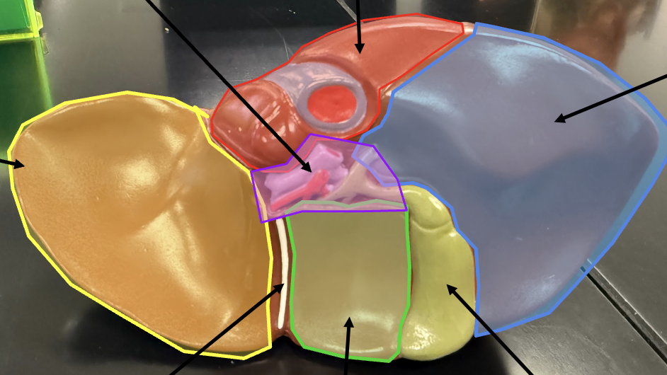<p>Caudate lobe ('“tail”)</p>