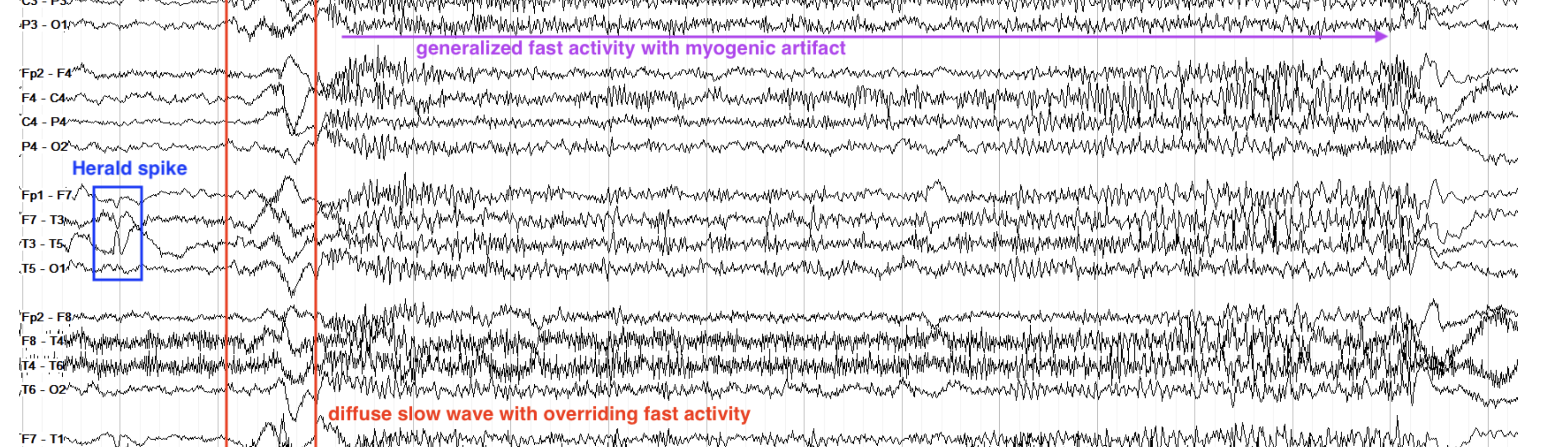 <p>herald spike→slowwave→generalized tonic</p>
