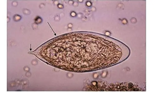 <p>Schistosoma haematobium, eggs, urine smear.</p><p>(Phylum Platyhelminthes, Subphylum Neodermata, Class Trematoda, Subclass Digenea, Family Schistosomatidae)</p><p>Note the terminal spine, miracidium, and shell.</p>