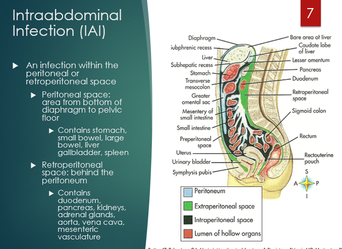 <p><span style="font-family: "Century Gothic";">An infection within the <strong><u>peritoneal </u></strong>or <strong><u>retroperitoneal space</u></strong></span></p><p></p>