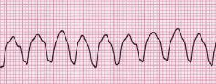 <p>Rate: 110-250</p><p>Regular: regular </p><p>QRS > 0.12</p>